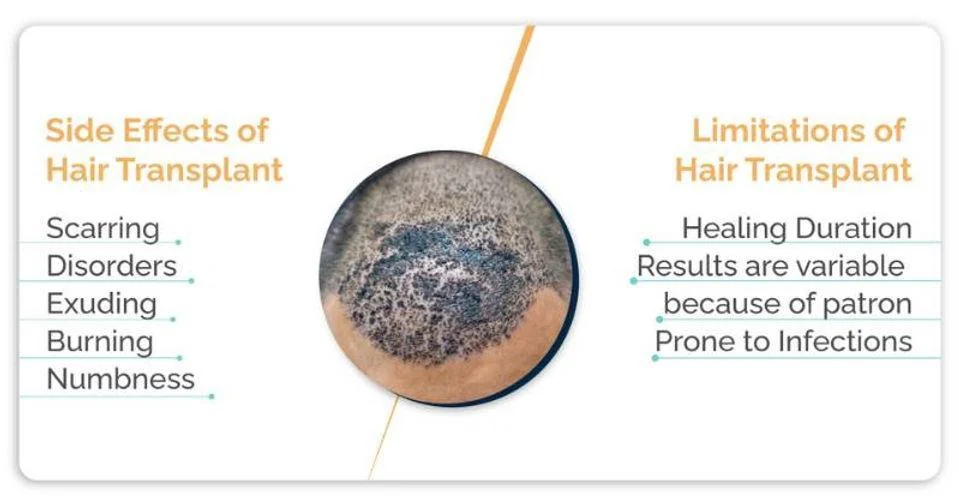 Side effects of hair transplant - scarring, disorders, exuding, burning and numbness