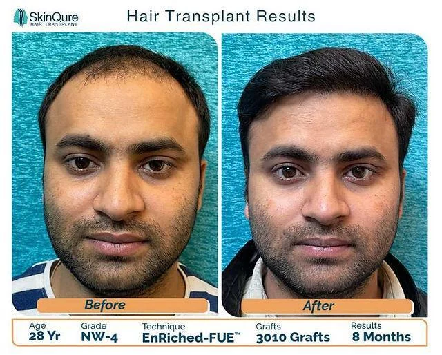 Hair transplant result at SkinQure - 28 years, NW-4, EnRiched-FUE, 3,010 grafts, 8 months