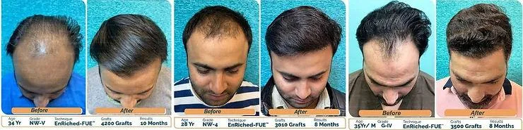 Finasteride After Hair Transplant: Its Role, Benefits & Cost - SkinQure, Delhi
