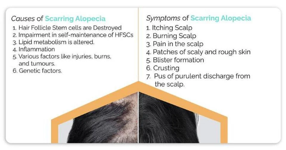Symptoms of scarring alopecia - itching, burning, pain, scaly patches, blisters, crusting and discharge