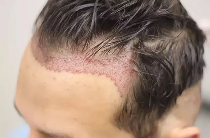 FUE hair transplant cost