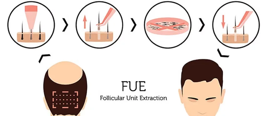 FUE hair transplant procedure
