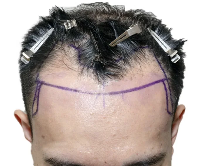 FUE hair transplant treatment