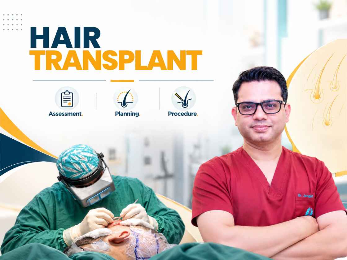 EnRiched-FUE hair transplant procedure at SkinQure Delhi